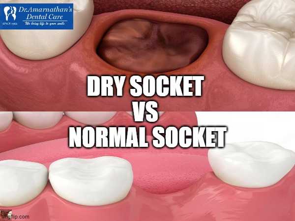 Dry socket vs Normal socket | DRY SOCKET 
VS 
NORMAL SOCKET | image tagged in dental,mental health,healthcare,healthy,smile,gum | made w/ Imgflip meme maker