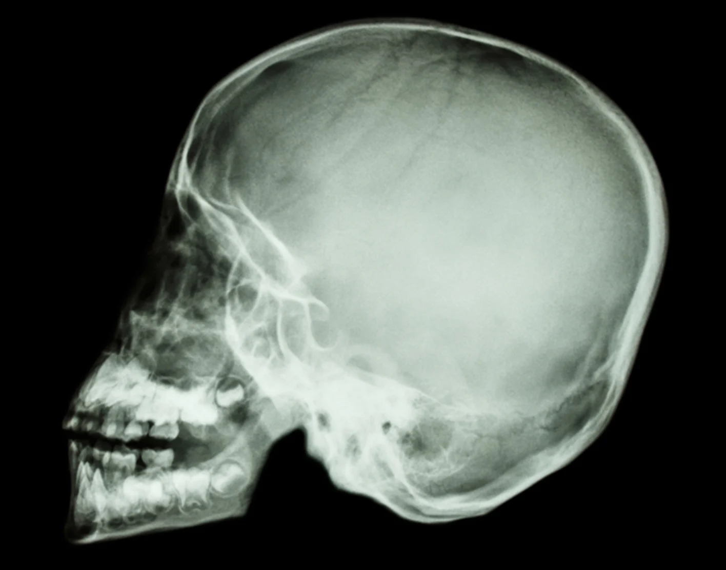 Brain x-ray meme Blank Meme Template