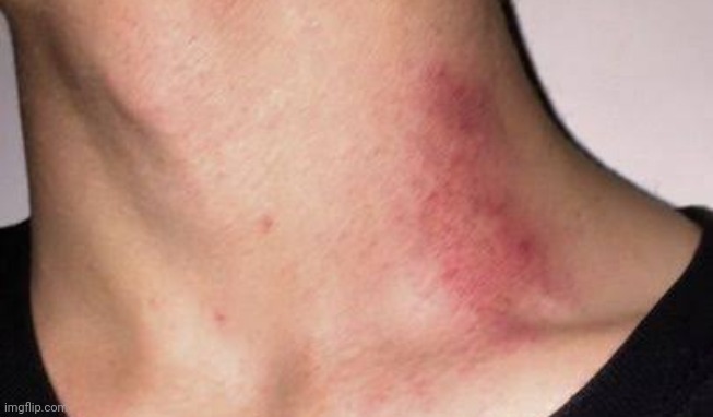 I think the hickey looks better now | made w/ Imgflip meme maker