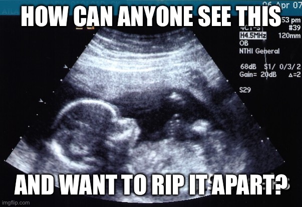 You can’t claim compassion for others and support abortion as birth control. | HOW CAN ANYONE SEE THIS; AND WANT TO RIP IT APART? | image tagged in ultrasound | made w/ Imgflip meme maker