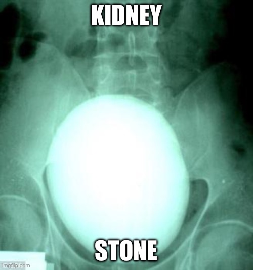 Kidney stone | KIDNEY STONE | image tagged in kidney stone | made w/ Imgflip meme maker