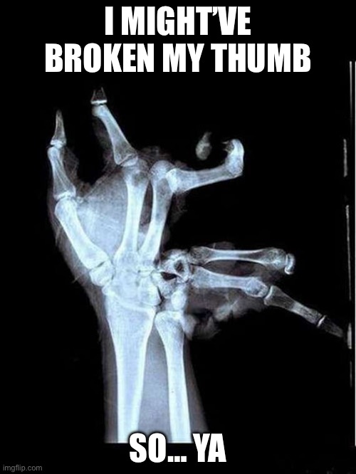 Oof | I MIGHT’VE BROKEN MY THUMB; SO… YA | image tagged in broken hand | made w/ Imgflip meme maker