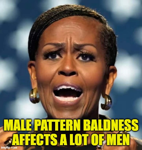 Male Pattern Baldness is a Trans Womens issue | MALE PATTERN BALDNESS AFFECTS A LOT OF MEN | image tagged in male privilege,bald,baldness,hairless,trans,michael | made w/ Imgflip meme maker