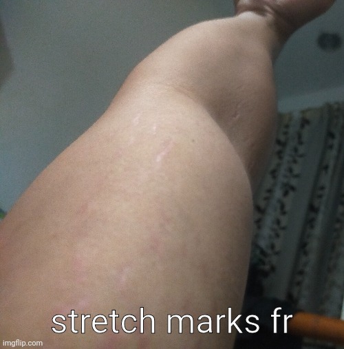 stretch marks fr | made w/ Imgflip meme maker