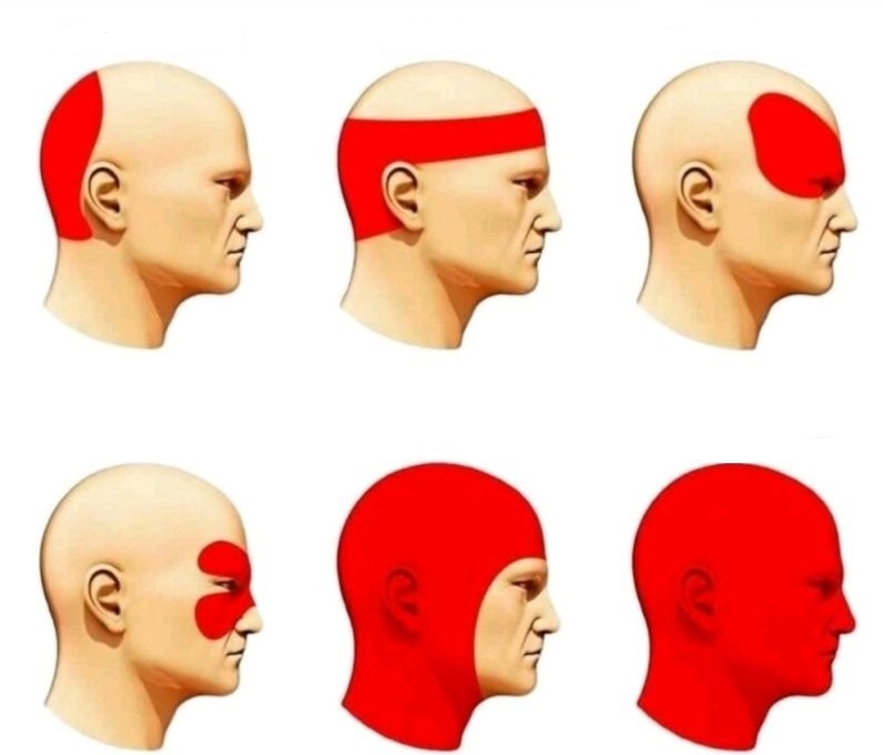 High Quality Headache Types Blank Meme Template