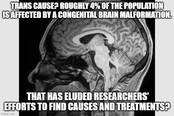 Is this the cause of Trans? | TRANS CAUSE? ROUGHLY 4% OF THE POPULATION IS AFFECTED BY A CONGENITAL BRAIN MALFORMATION. THAT HAS ELUDED RESEARCHERS’ EFFORTS TO FIND CAUSES AND TREATMENTS? | image tagged in is this the cause of trans | made w/ Imgflip meme maker