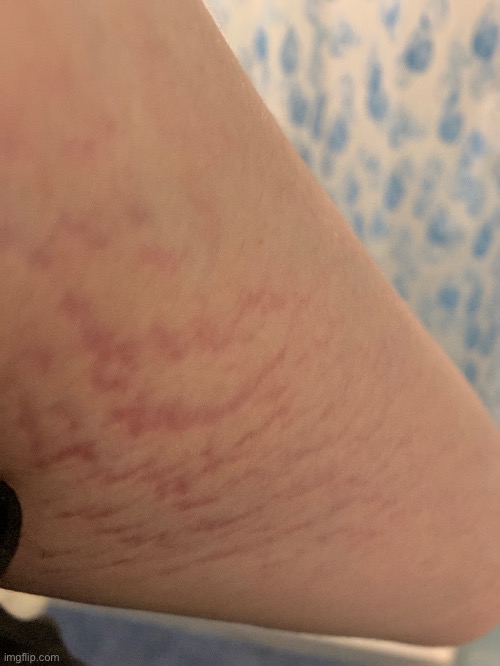 Does anyone know what these marks are? (Yes that's my arm) | made w/ Imgflip meme maker