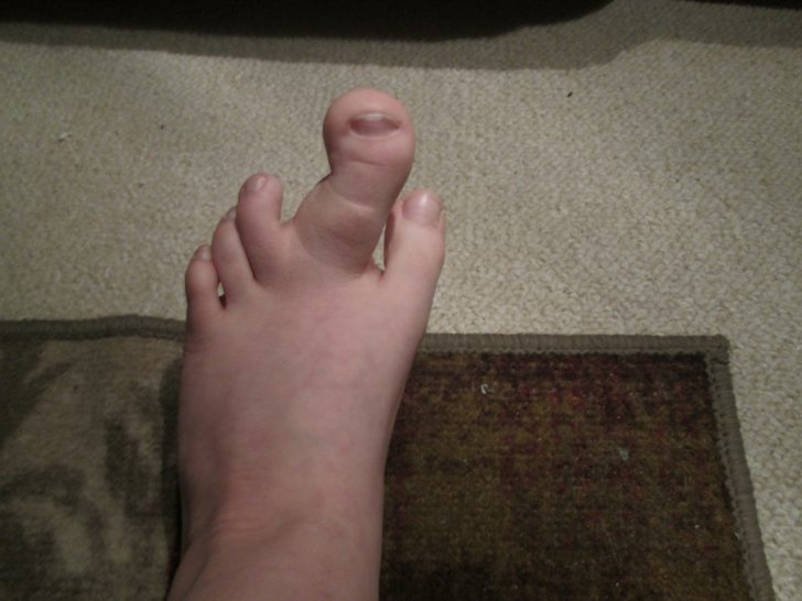 High Quality mutated toe Blank Meme Template