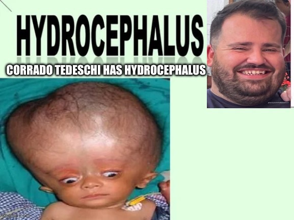 Corrado Tedeschi Has Hydrocephalus | image tagged in big head,big brain,big book small book,yeah this is big brain time | made w/ Imgflip meme maker