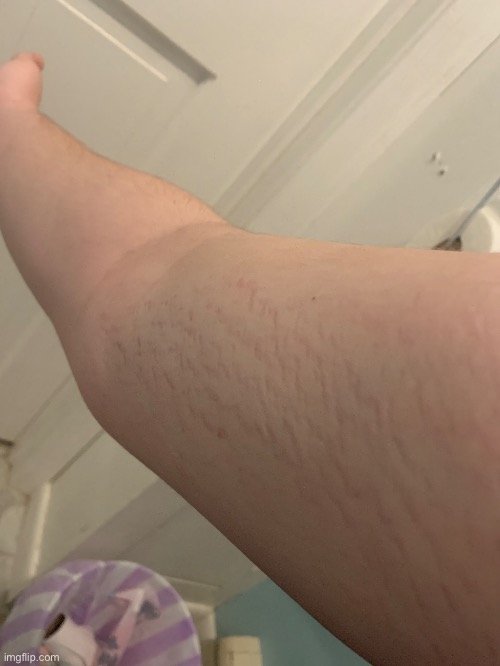 There's more stretch marks now .-. | made w/ Imgflip meme maker