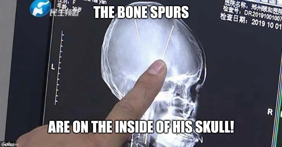 Brain worms X ray | THE BONE SPURS ARE ON THE INSIDE OF HIS SKULL! | image tagged in brain worms x ray | made w/ Imgflip meme maker