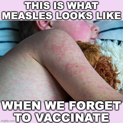 Measles is the canary in the coal mine of endemic diseases | THIS IS WHAT MEASLES LOOKS LIKE; WHEN WE FORGET TO VACCINATE | image tagged in measles child,measles,disease,vaccines | made w/ Imgflip meme maker