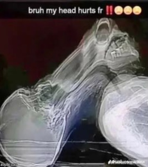 how does one even get such an X-ray | image tagged in my head hurts | made w/ Imgflip meme maker