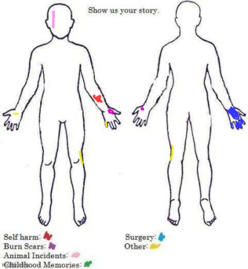 yellow is scars from cuts and stuff. (I had surgeries on my fingers bc they kept locking up) | image tagged in show us your story | made w/ Imgflip meme maker