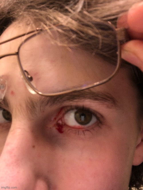 HOW THE HELL DID THIS HAPPEN? I AM BLEEDING OUT MY EYE LIKE A DAMN HORNED TOAD. | made w/ Imgflip meme maker