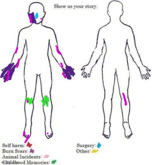 The burn scars healed tho | image tagged in show us your story | made w/ Imgflip meme maker