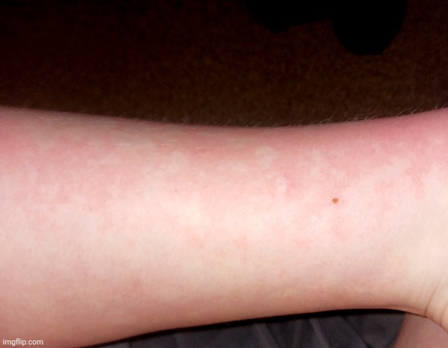 What's this red blotting on my skin | made w/ Imgflip meme maker