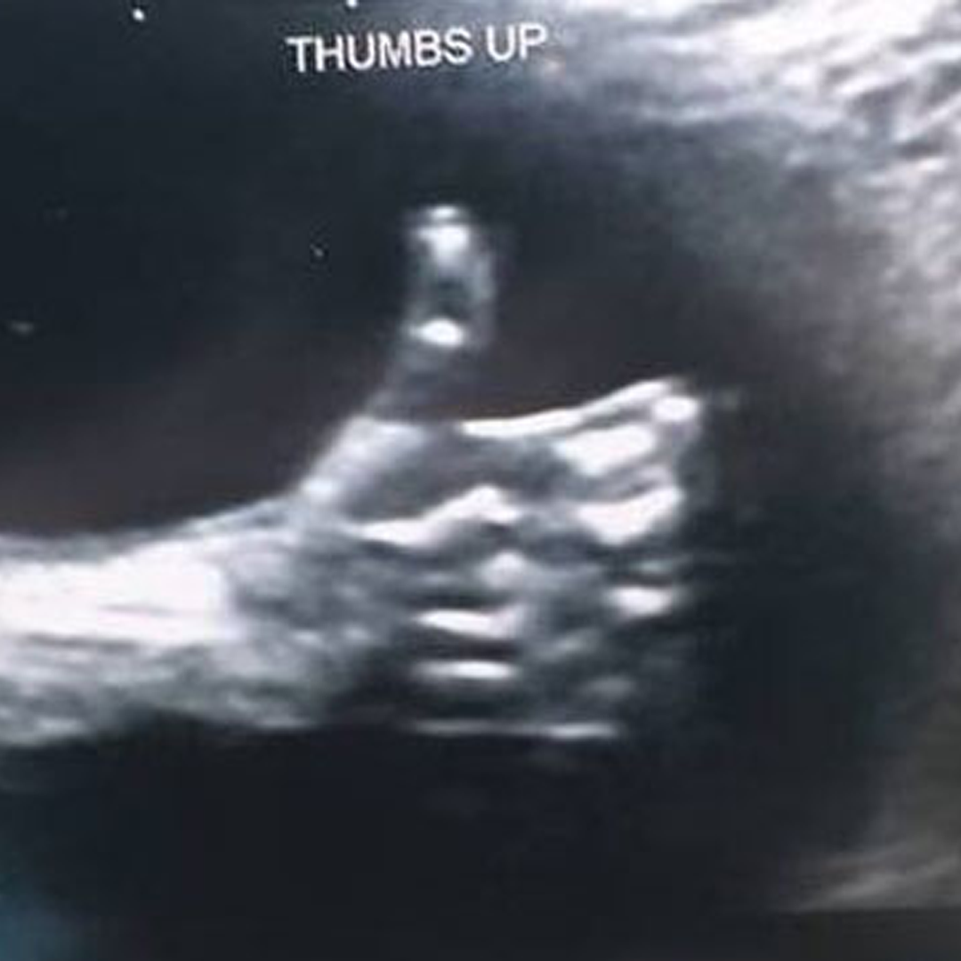 Baby Ultrasound Blank Meme Template