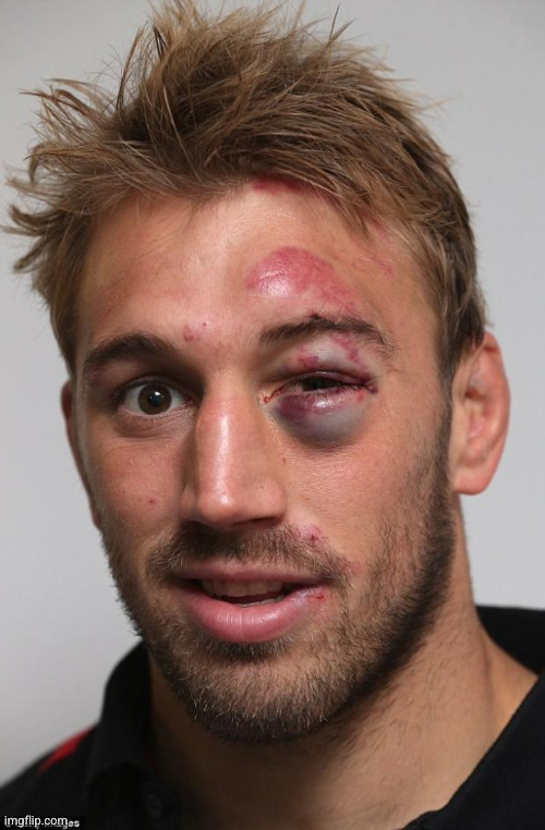 black eye | image tagged in black eye | made w/ Imgflip meme maker