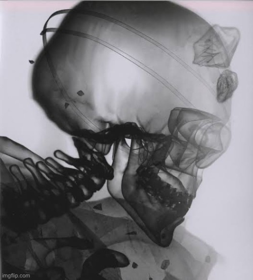 x-ray I had today, I don't think I'm okay and i can’t remember anything either | image tagged in surgery | made w/ Imgflip meme maker