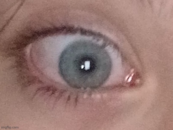 Update on my eye (this is the better one) | made w/ Imgflip meme maker