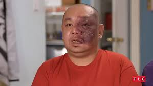 Man with Birth Mark on Face Blank Meme Template