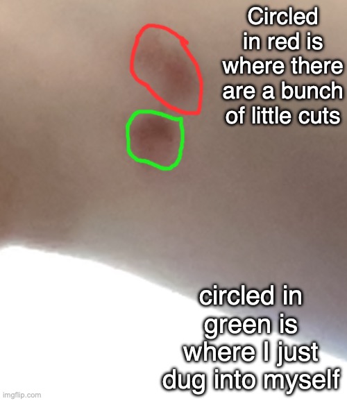 the image quality is garbage, I'm on my computer and the webcam is awful | Circled in red is where there are a bunch of little cuts; circled in green is where I just dug into myself | made w/ Imgflip meme maker