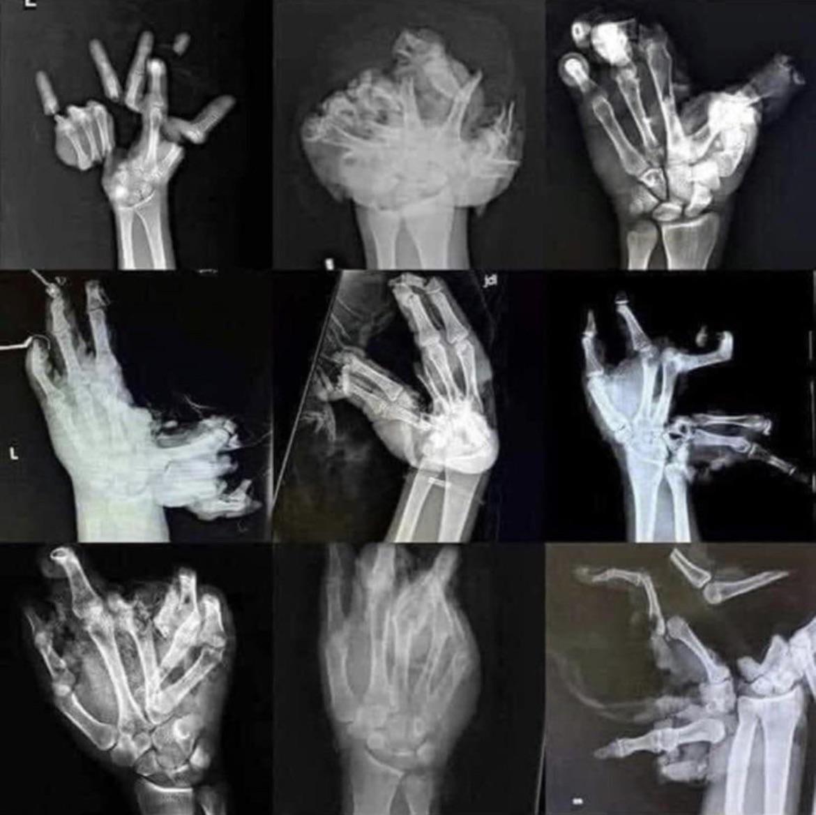 Hand fractures Blank Meme Template