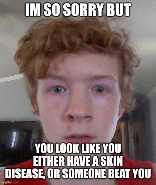 street rat ptsd | IM SO SORRY BUT; YOU LOOK LIKE YOU EITHER HAVE A SKIN DISEASE, OR SOMEONE BEAT YOU | image tagged in street rat ptsd | made w/ Imgflip meme maker