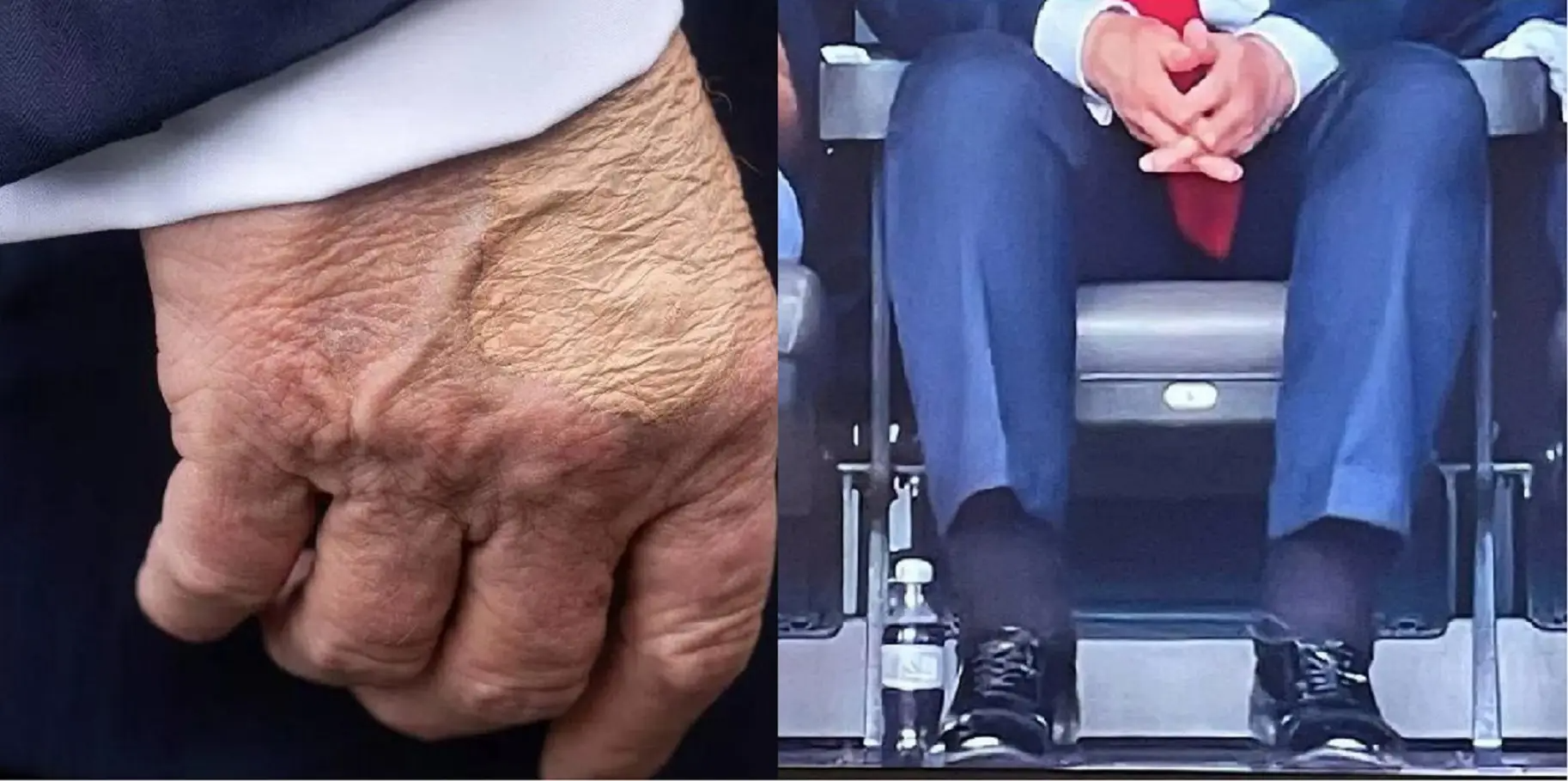 Trump cankles and bruised hand makeup Blank Meme Template