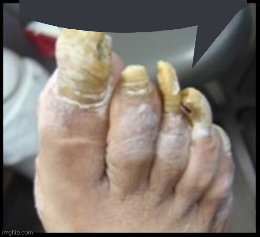 Ugly Toe Nails | image tagged in ugly toe nails | made w/ Imgflip meme maker