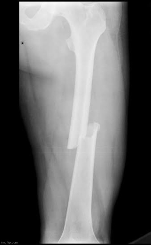 Femur fracture | image tagged in femur fracture | made w/ Imgflip meme maker