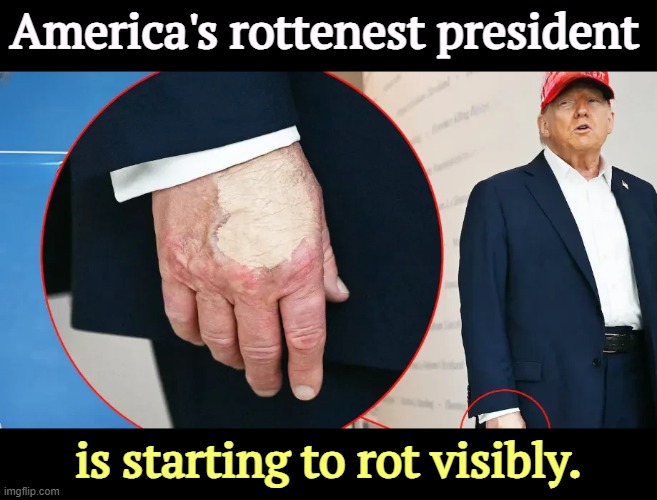 Trump is frightened. He should be. | America's rottenest president; is starting to rot visibly. | image tagged in trump,rotten,hand,bruise,sore | made w/ Imgflip meme maker