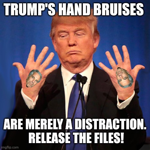File this away, Dr. Epstein! | TRUMP'S HAND BRUISES; ARE MERELY A DISTRACTION.  RELEASE THE FILES! | image tagged in trump hands,donald trump,jeffrey epstein,sickness,pedobear | made w/ Imgflip meme maker