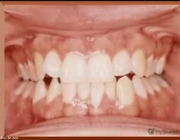straight teeth | made w/ Imgflip meme maker