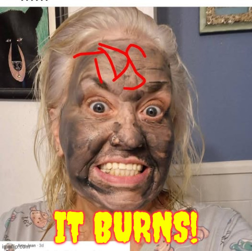 TDS... It burns | IT BURNS! | image tagged in political,reposts,tds,burns | made w/ Imgflip meme maker