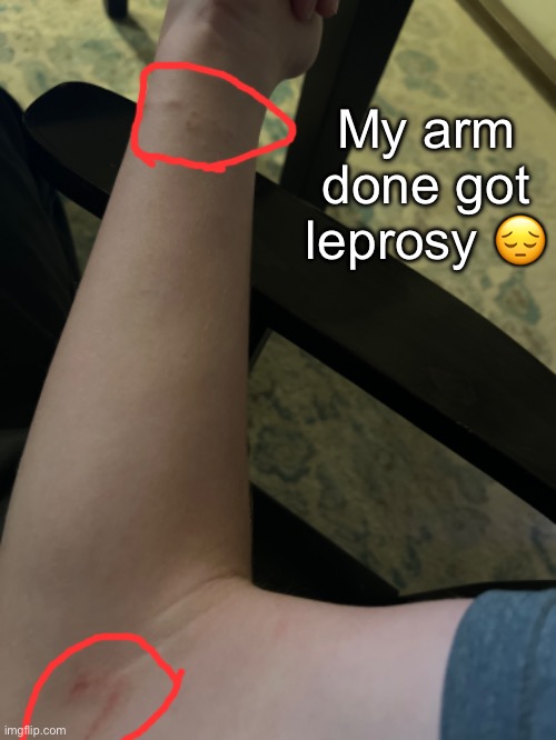 The lower one is definitely a friction burn but the top one is a myery rash | My arm done got leprosy 😔 | made w/ Imgflip meme maker