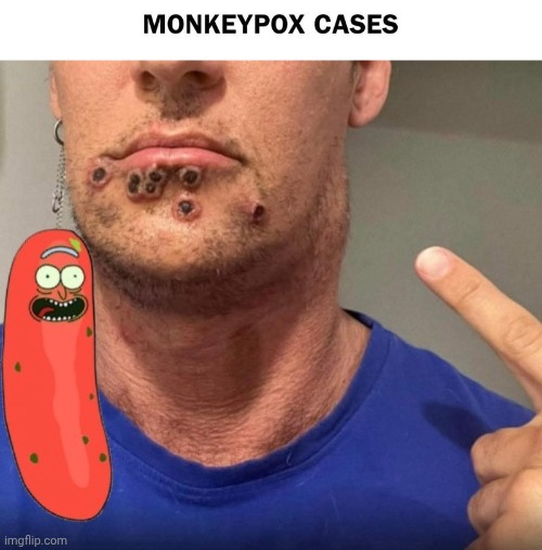 Monkey Pox victim Blank Meme Template