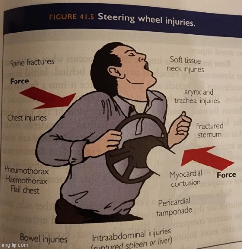 image tagged in steering wheel injuries | made w/ Imgflip meme maker