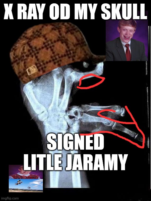Picure of me i will shared | X RAY OD MY SKULL; SIGNED LITLE JARAMY | image tagged in broken hand | made w/ Imgflip meme maker