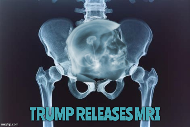 Released Trump MRI | image tagged in released trump mri,head up ass,no crowns area,trump is never pooped out,maga mirage | made w/ Imgflip meme maker