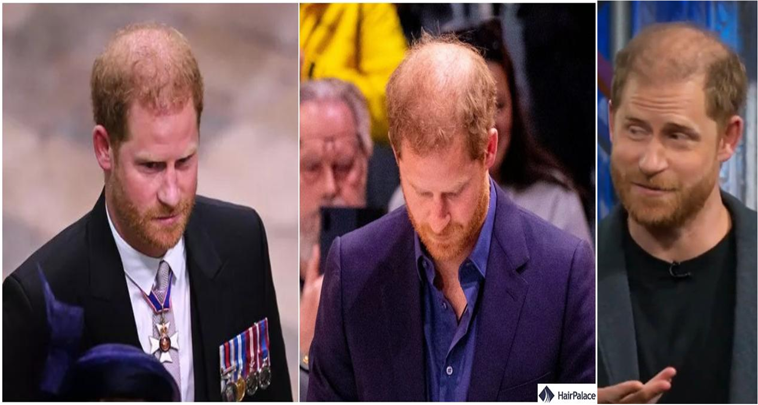 Bald Prince Harry Blank Meme Template