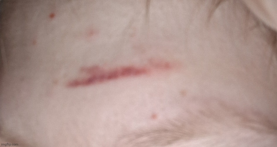 I bruised my forehead attempting to pop a zit using tweezers | made w/ Imgflip meme maker