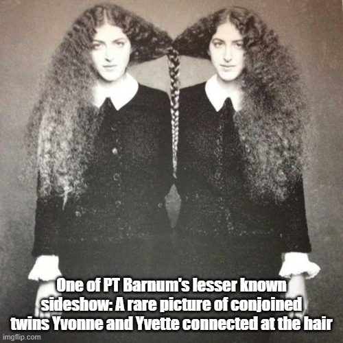 Medical Miracle | One of PT Barnum's lesser known sideshow: A rare picture of conjoined twins Yvonne and Yvette connected at the hair | image tagged in sideshow,circus,attraction,medical miracle | made w/ Imgflip meme maker