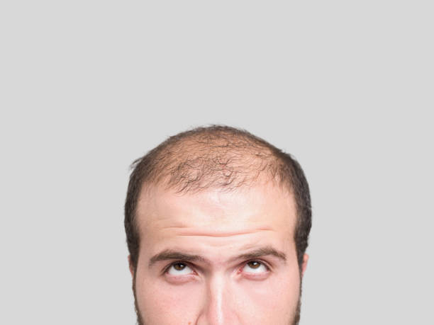 Balding Men Blank Meme Template