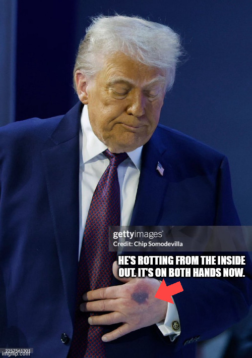 HE'S ROTTING FROM THE INSIDE OUT. IT'S ON BOTH HANDS NOW. | made w/ Imgflip meme maker