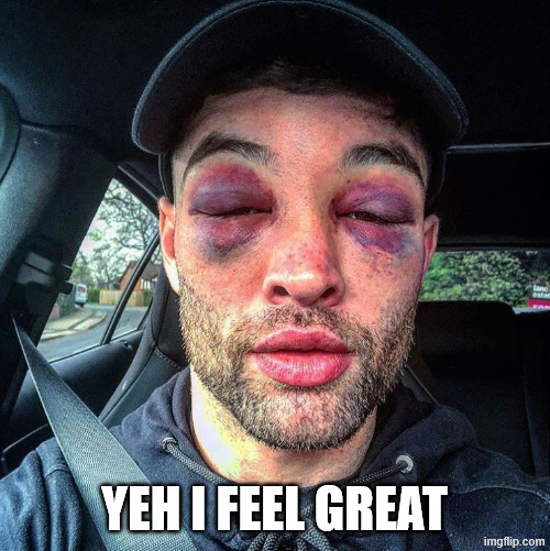 Double black eye | YEH I FEEL GREAT | image tagged in double black eye | made w/ Imgflip meme maker