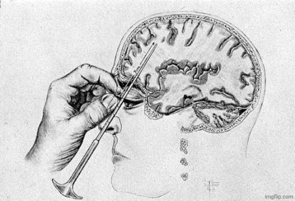 Lobotomy  | image tagged in lobotomy | made w/ Imgflip meme maker