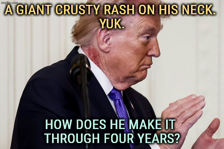 A GIANT CRUSTY RASH ON HIS NECK. 
YUK. HOW DOES HE MAKE IT 
THROUGH FOUR YEARS? | image tagged in trump,disease,old,decay,illness,medicine | made w/ Imgflip meme maker