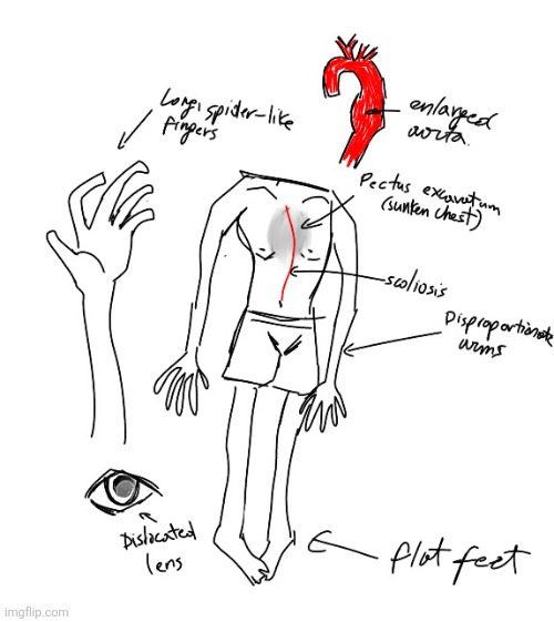 Drew some characteristics of marfan syndrome i was bored | image tagged in drawing | made w/ Imgflip meme maker